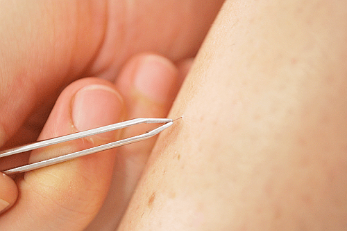tweezers poils incarnés Se débarrasser des poils incarnés tweezers
