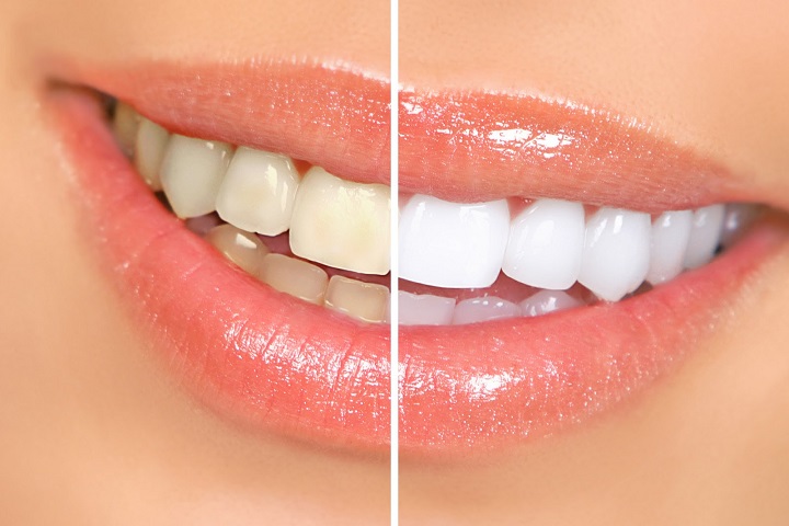 dents Le blanchiment des dents et la revue du kit 3D CREST WHITE o dental